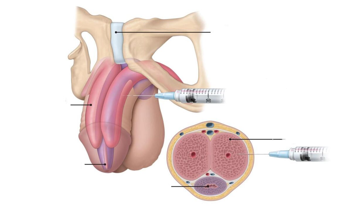 inxeccións para a ampliación do pene