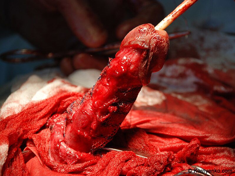 instalación dunha matriz de coláxeno para a ampliación do pene