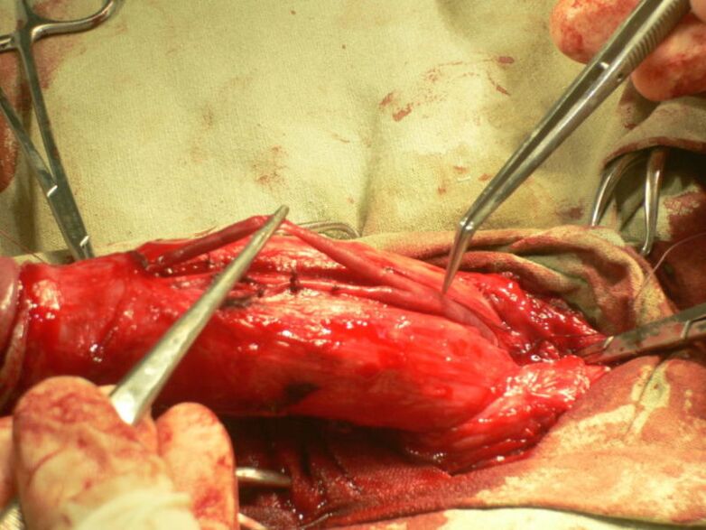 lipofilling do pene para a ampliación