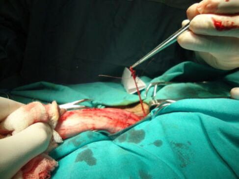 cirurxía de ampliación do pene