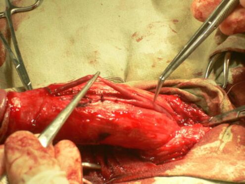 realizando unha cirurxía de ampliación do pene