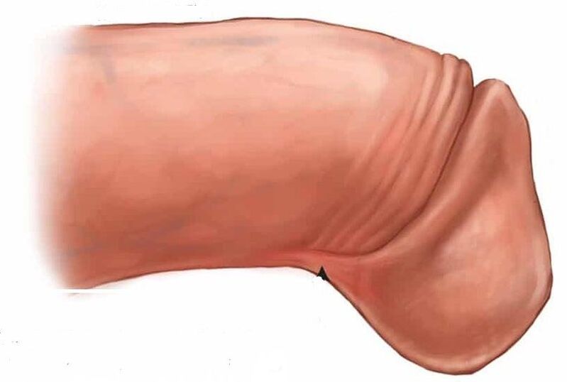 como aumentar o glande do pene