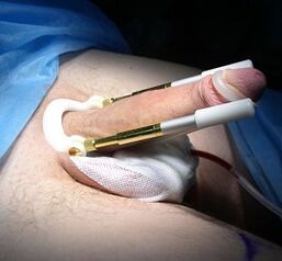 Como se realiza a cirurxía de ampliación do pene